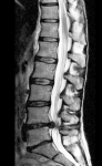 large lumbar herniated disc bc