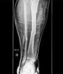 leg xray