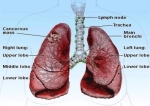 lung cancer