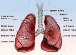 lung cancer new