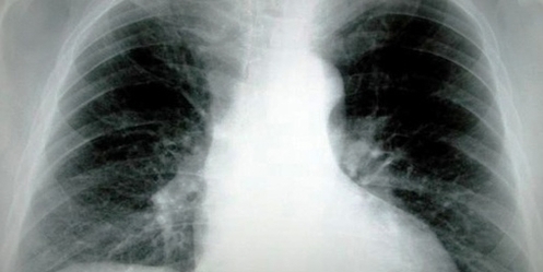 lung cancer ray