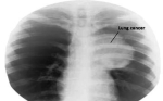 lung cancer ray1