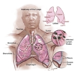 lung cancer symptoms