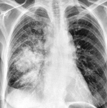 lung cancer xray