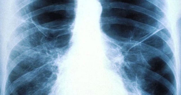 lung xray ve