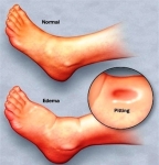 mcdc edema foot