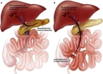 metastatic pancreatic neuroendocrine