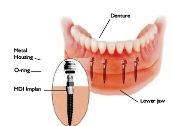 mini dental implant sanjuan