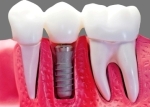 mini dental implants