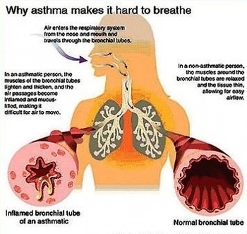 natural asthma remedy