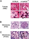 nephrogenic diabetes insipidus