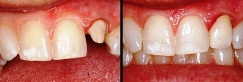 ohmes tooth prepared for crown