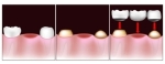 pdm dental bridge procedure