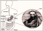 peptic ulcer