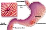 peptic ulcers lg enlg