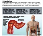 photo colon polyps lead colon cancers