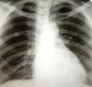 photo lung cancer ray