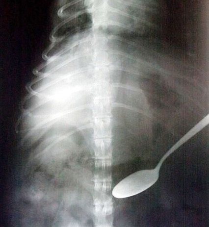 pica swallowed spoon ray foreign object funny