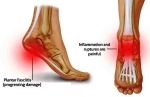 plantar fasciitis big photos