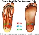 plantar fasciitis pain map tt tennis warehouse com