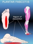 plantarfascitis region of discomfort images