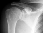 posterior shoulder dislocation