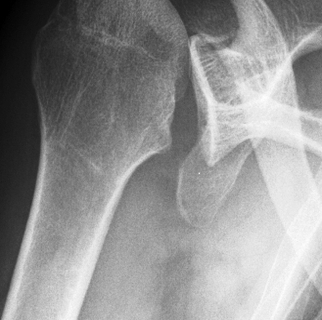 posterior shoulder dislocation figure