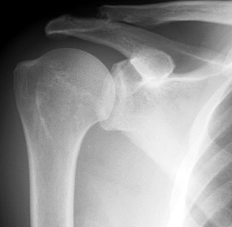 posterior shoulder dislocation image