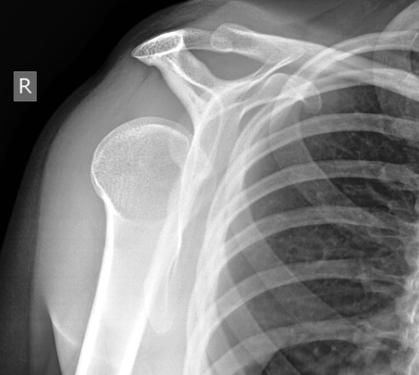 posterior shoulder dislocation1
