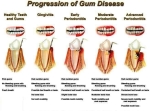 progression of gum disease