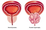 prostate cancer