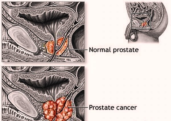 prostate cancer rnkb