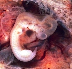 px tubal pregnancy with embryo