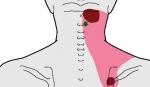 referral multifidi mid cervical