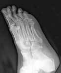 right foot ray thumb