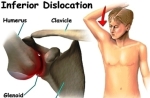 shoulder dislocation anatomy