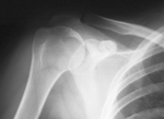 shoulder instability xray photo