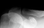 shoulder xray acj normal