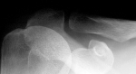 shoulder xray acj normaltures