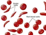 sickle cell anemia