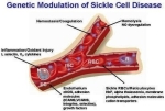 sickle cell disease