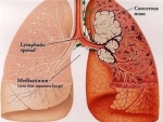 small cell lung cancer