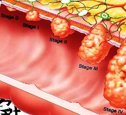 stages colon cancer