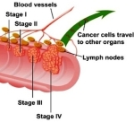 stages coloncancer web