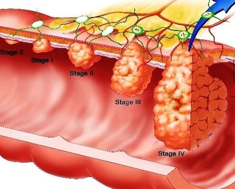 stages of colon cancer