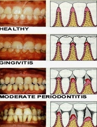 stages of periodontitis