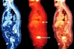 stages of prostate cancer