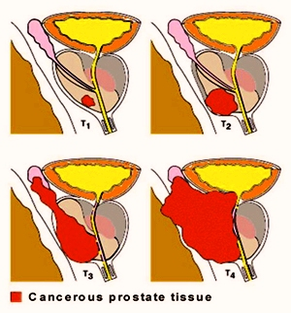 stages prostate cancer