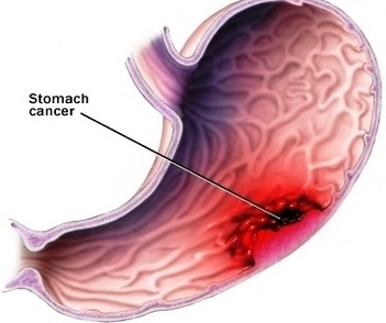 stomach cancer tumor
