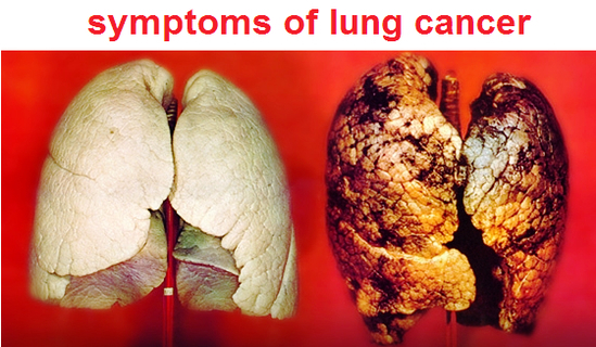 symptoms lung cancer